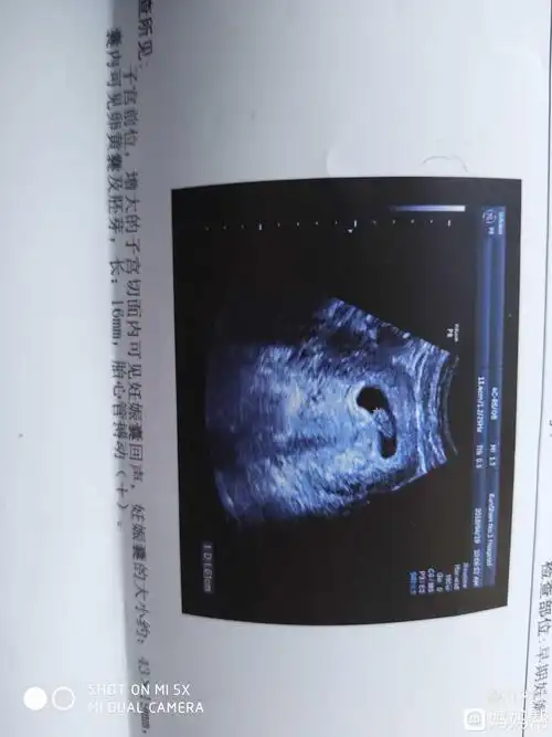 首选!通过孕囊教你看男女"优雅诞生"-第1张图片-途临网