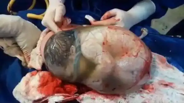 一名西班牙婴包在羊膜囊内出生.(图/翻摄「gih flor de lis」脸书)